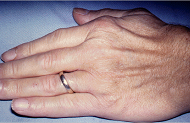 Causes of Rheumatoid Arthritis