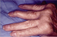 Rheumatoid Arthritis Different Cause
